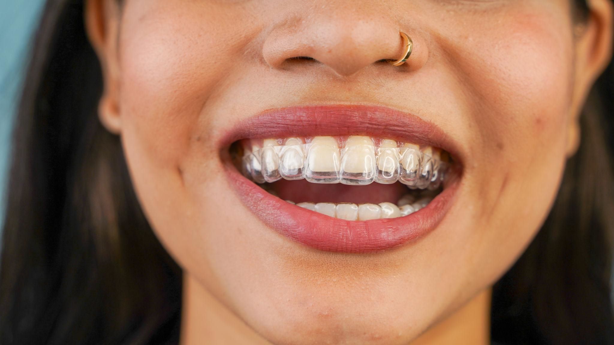 Orthodontics & Clear Aligners
